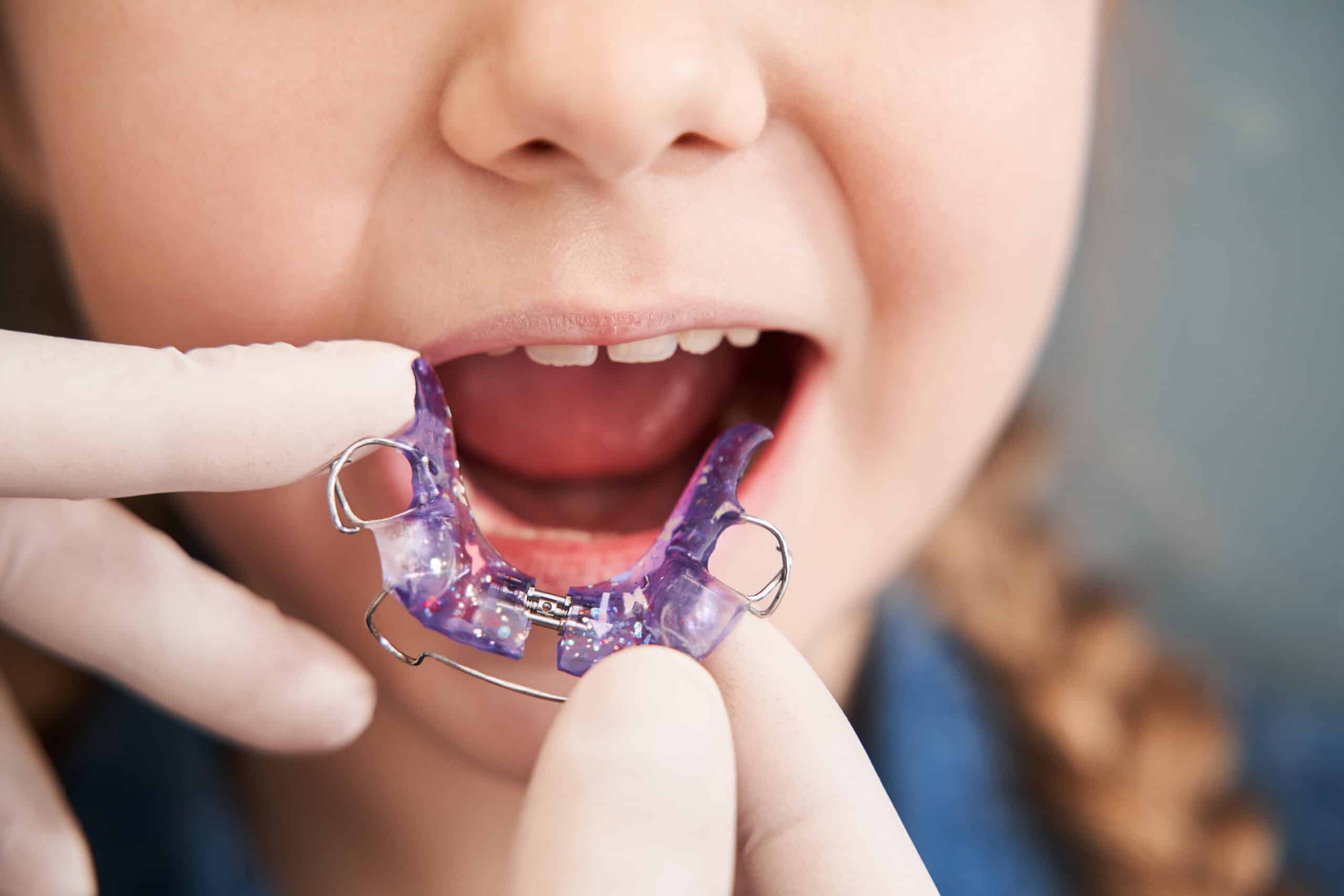 A child's mouth is open wide to show a dental appliance, a purple orthodontic retainer, being placed by a gloved hand. The child has braided hair and appears to be in a dental office setting.