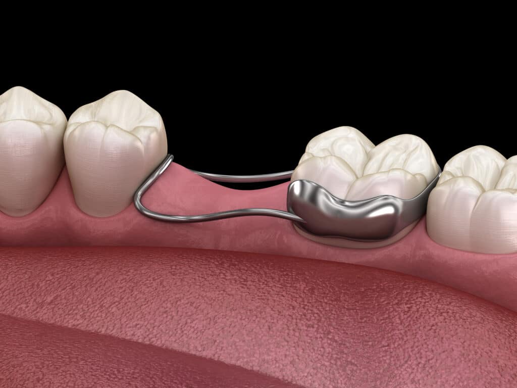 A close-up illustration of a dental space maintainer attached to a molar in a simulated gumline. The metallic device is curved and positioned in the space created by a missing tooth, with healthy adjacent teeth visible.